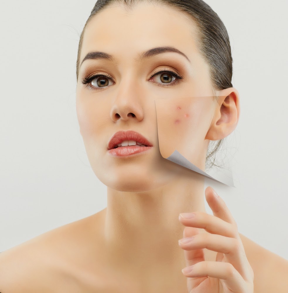 Melasma